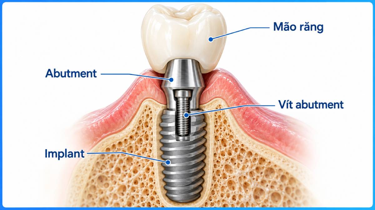 Vít abutment là linh kiện liên kết abutment với Implant, không phải chính abutment hay trụ Implant.